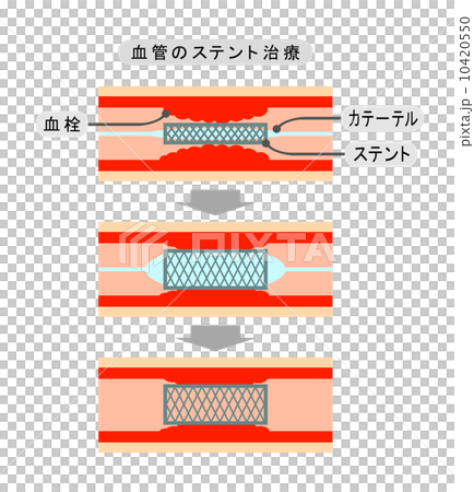 血管のステント治療 10420550