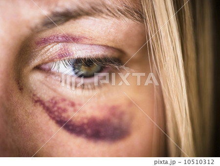 Portrait of woman with black eye 10510312