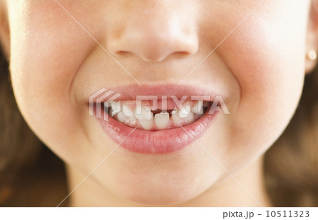 Close-up of girl's (2-3) mouth with some teeth missing Close-up of girl's (2-3) mouth with some teeth missing 10511323