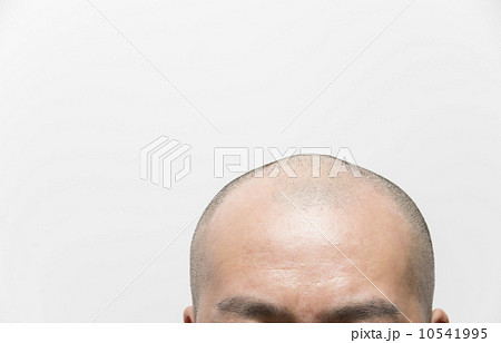 育毛イメージ　薄毛男性の頭 10541995