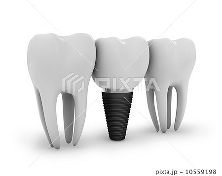 tooth implant tooth implant 10559198