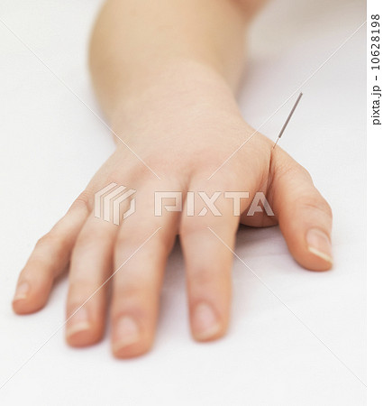 Woman receiving acupuncture 10628198