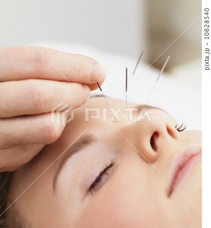 Woman receiving acupuncture 10628540