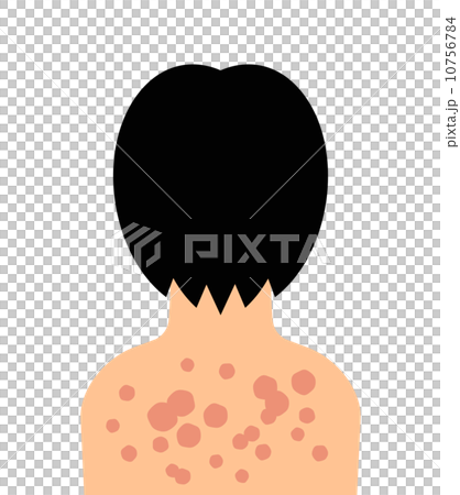 帶狀皰疹在背部做 10756784