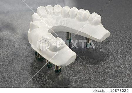 Plaster model of teeth Plaster model of teeth 10878026