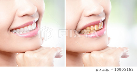 woman teeth before and after whitening 10905165