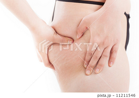 30代女性のお尻のセルライト 11211546