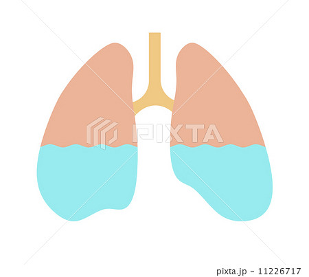 肺に溜まった水のイラスト素材