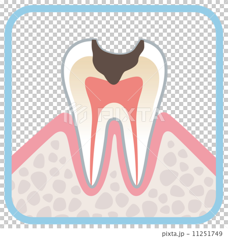 Sectional view of teeth decayed tooth Sectional view of teeth decayed tooth 11251749