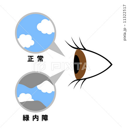 緑内障の症状 緑内障の症状 11322517