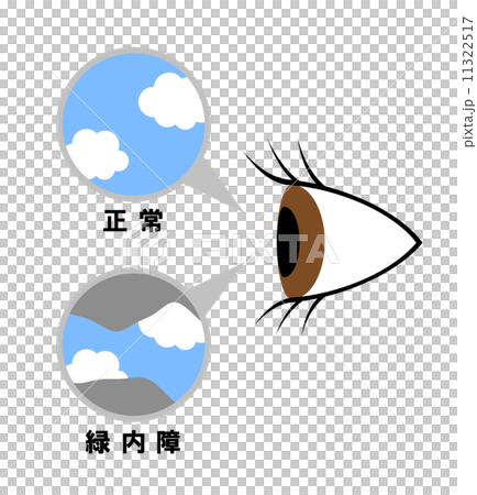 緑内障の症状 緑内障の症状 11322517