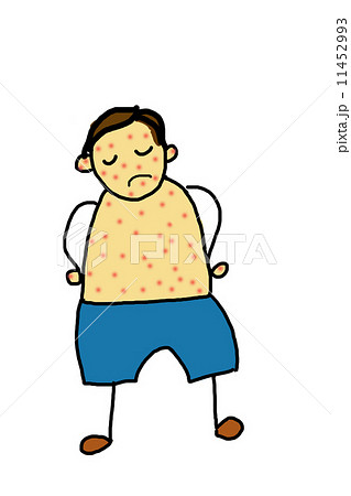 little boy is sick with chickenpox - Stock Illustration [11452993] - PIXTA