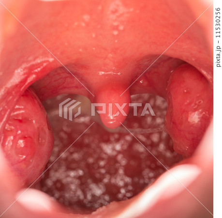Open mouth view of tonsils Open mouth view of tonsils 11530256