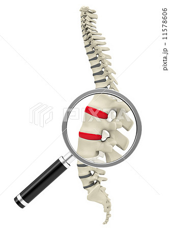Disc prolapse 11578606