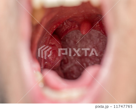 Open mouth view of tonsils Open mouth view of tonsils 11747765