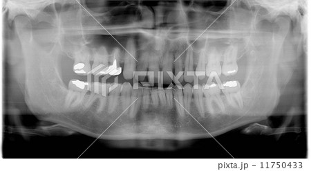 rtg (x-ray) photo of man teeth rtg (x-ray) photo of man teeth 11750433