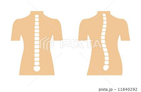 正常な背骨と歪んだ背骨のイラスト素材