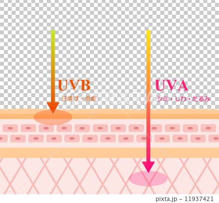 A cross-sectional explanation of how UV rays irritate the skin 11937421