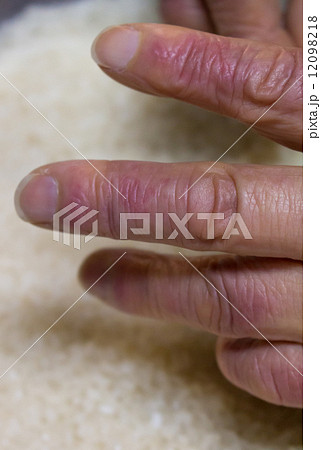 おばあちゃんのしもやけ 12098218