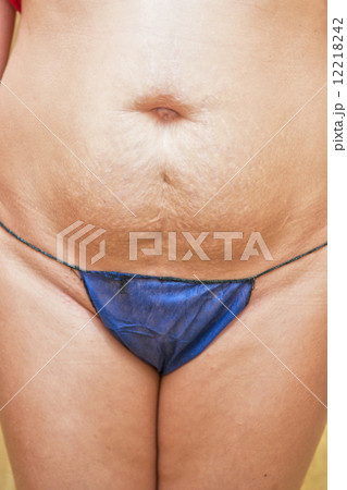skin stretch skin stretch 12218242