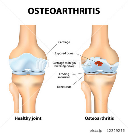 Osteoarthritis or arthritis 12229256