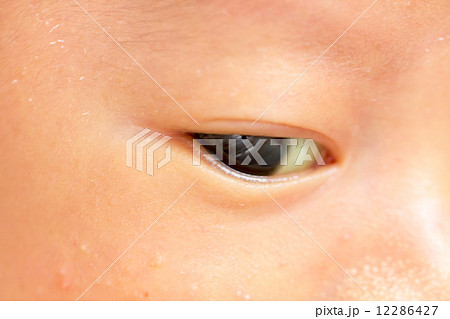 生後1ヶ月 赤ちゃん 黄疸の写真素材