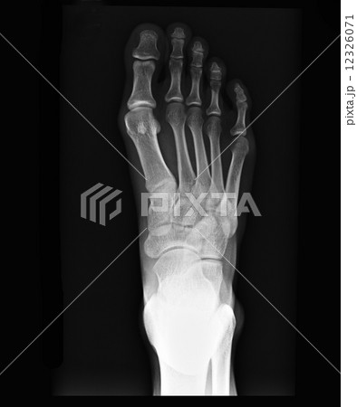 x-ray of foot 12326071