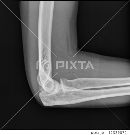 X-ray view of elbow 12326072