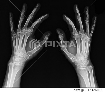 X-ray of hand 12326083