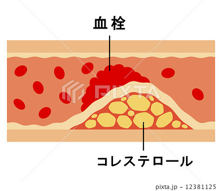 動脈硬化の図 12381125