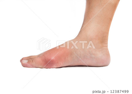Foot with inflamed gout Foot with inflamed gout 12387499