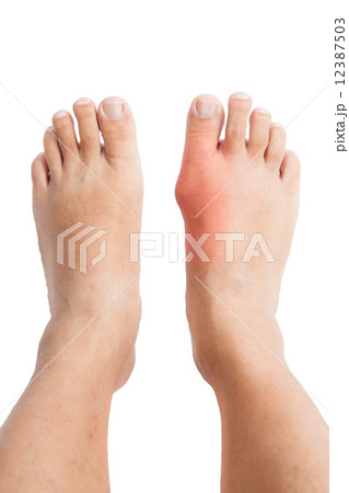 A pair of feet with the right foot inflamed with gout, left foot normal 12387503