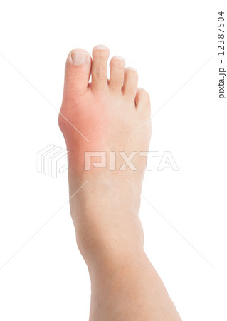 Foot with gout inflamation 12387504