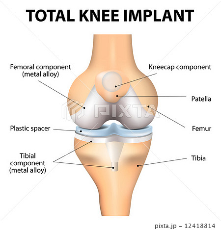 Components of a Knee Replacement 12418814