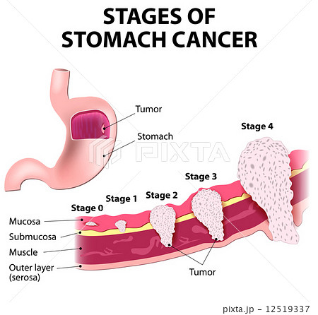 Staging of stomach cancer Staging of stomach cancer 12519337