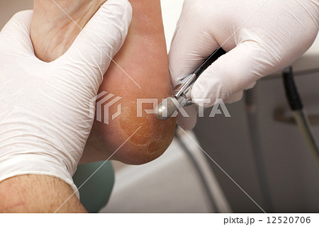 Remove skin with a grinder 12520706