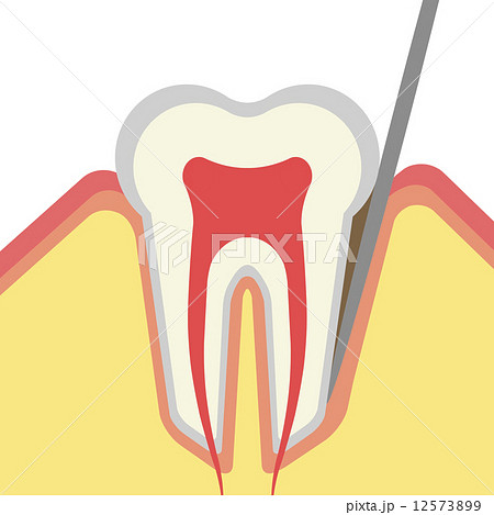 歯周ポケットのイラスト素材