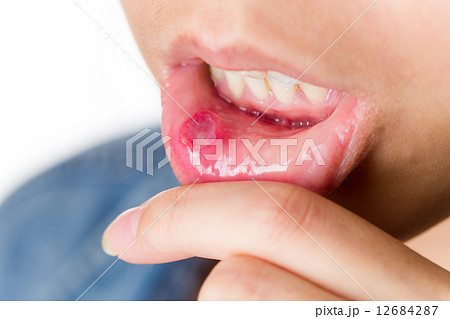 Woman suffer from mouth aphtha 12684287