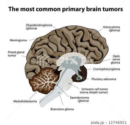 The most common primary brain tumors 12746921