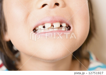 歯の矯正をする女の子の写真素材