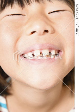 歯の矯正をする女の子の写真素材