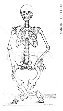 Skeleton deformed by rickets, vintage engraving. 12811018