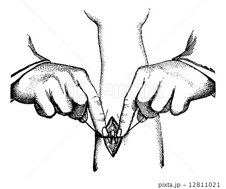Ligation of the artery. Way to tighten the wire, vintage engravi 12811021