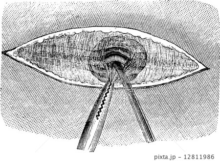 Isolation of the artery, vintage engraving. 12811986