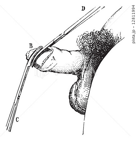 Operation of phimosis by circumcision, vintage engraving. 12811994