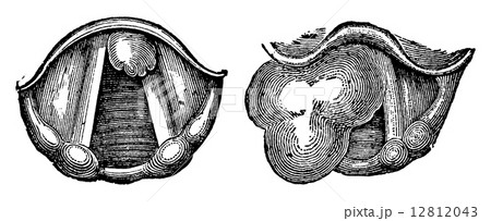 Fibroids of the Larynx, vintage engraving Fibroids of the Larynx, vintage engraving 12812043