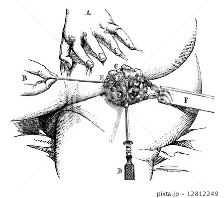 Removal of a hemorrhoidal pad with a linear crusher, vintage eng 12812249