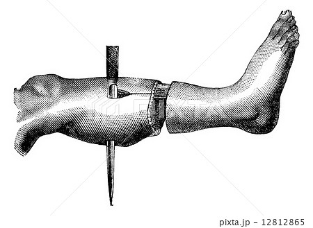 Amputation of the leg by the method has two flaps (formation of Amputation of the leg by the method has two flaps (formation of 12812865