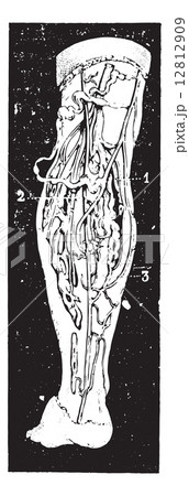 Varicose veins of the leg, vintage engraving. 12812909