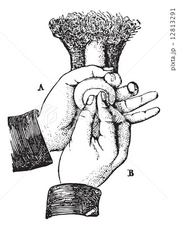 Reduction of paraphimosis the ordinary method, vintage engraving Reduction of paraphimosis the ordinary method, vintage engraving 12813291